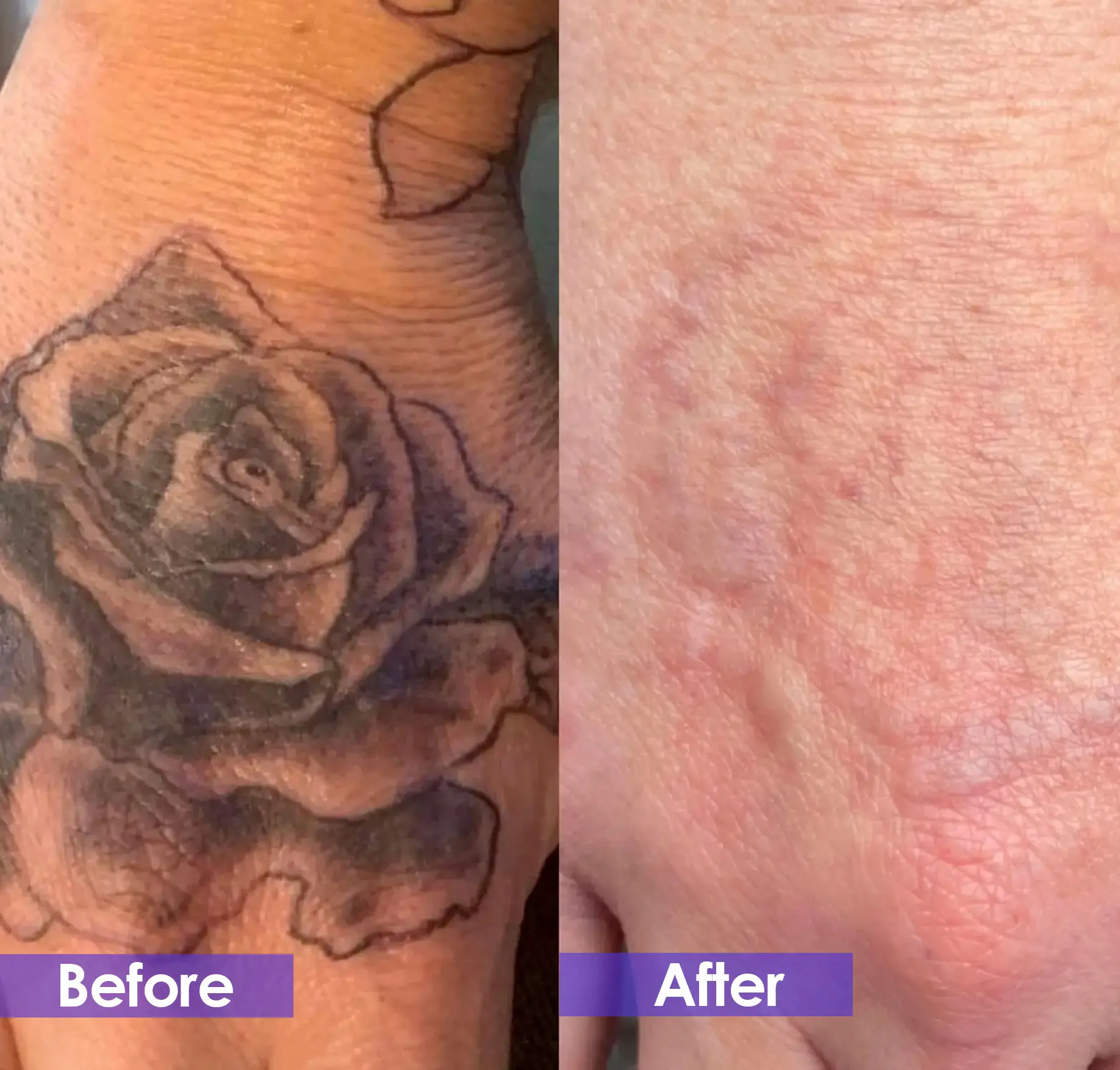 pico laser treatment after - Rose tattoo removal on the back of hand